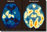 depression brain scan